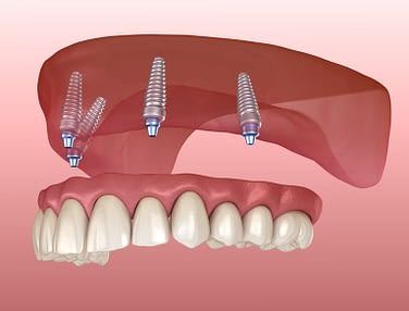 Implant Dentures in El Paso, TX - Dentist Near Me - El Paso Dental Office