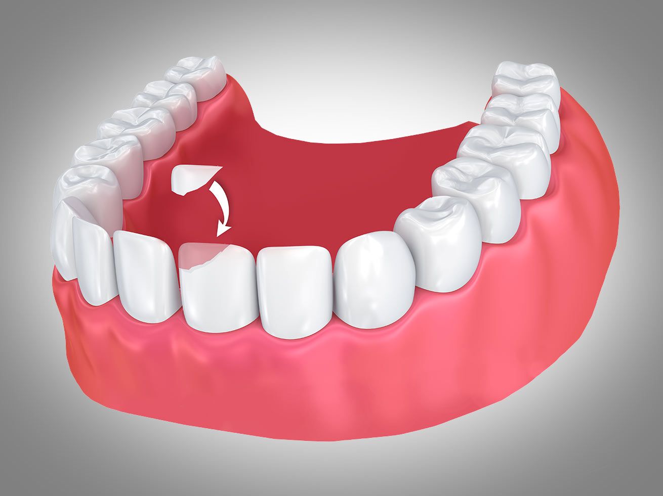 A Guide to Dental Bonding Repair Your Broken Tooth Dentista cerca de