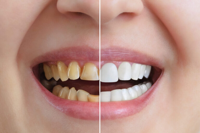 Cosmetic Dentistry: The Art of Perfecting Your Smile for Photos