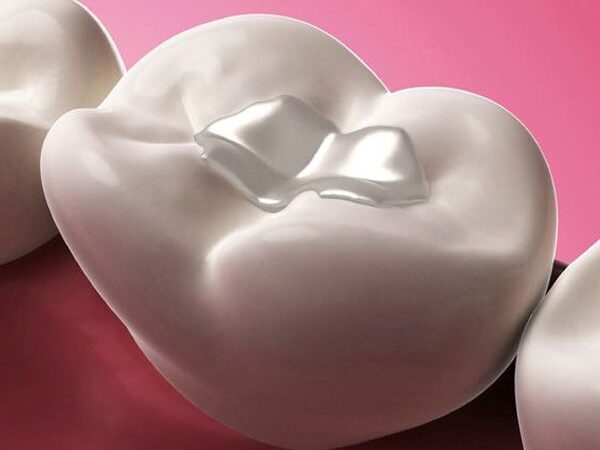 The Good News About Needing a Tooth Filling in El Paso, TX